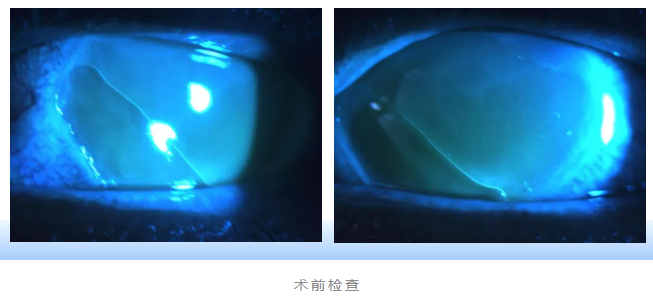 眼外傷